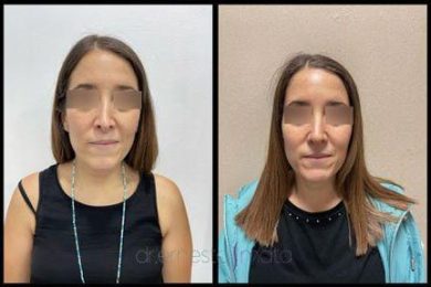 DR-ERNESTO-MATA-RONOPLASTIA-SECUN-3