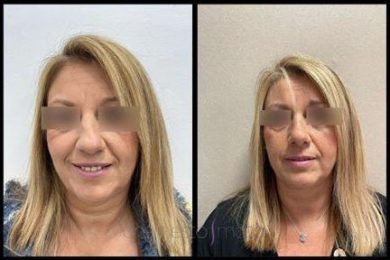 DR-ERNESTO-MATA-RONOPLASTIA-SECUN-4