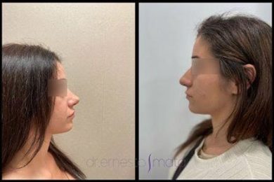 DR-ERNESTO-MATA-RONOPLASTIA-ULTRA03