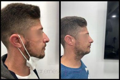 DR-ERNESTO-MATA-RONOPLASTIA-ULTRA05