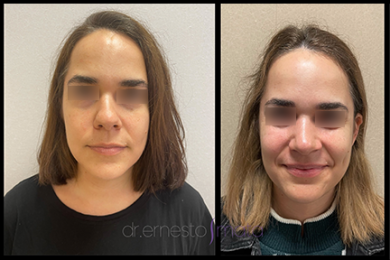 DR-ERNESTO-MATA-RONOPLASTIA-ULTRA15