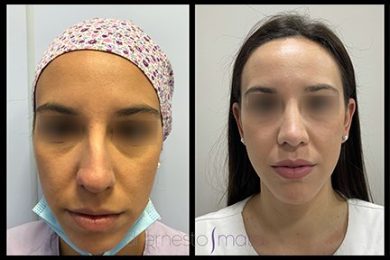 DR-ERNESTO-MATA-RONOPLASTIA-ULTRA16