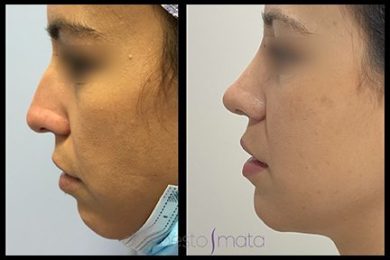 DR-ERNESTO-MATA-RONOPLASTIA-ULTRA17