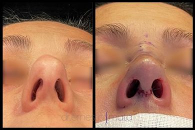 DR-ERNESTO-MATA-RONOPLASTIA-ULTRA19