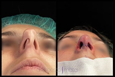 DR-ERNESTO-MATA-RONOPLASTIA-ULTRA20