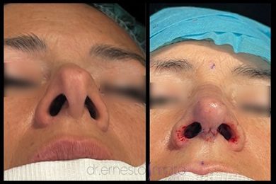 DR-ERNESTO-MATA-RONOPLASTIA-ULTRA21