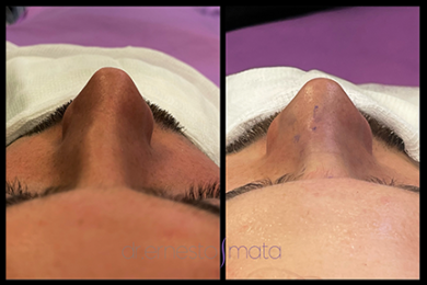 DR-ERNESTO-MATA-RONOPLASTIA-ULTRA22
