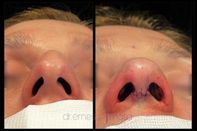 DR-ERNESTO-MATA-RONOPLASTIA-ULTRA23