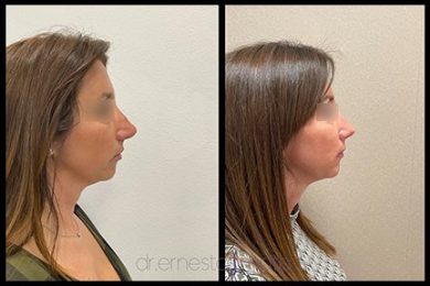 DR-ERNESTO-MATA-RONOPLASTIA-ULTRA25