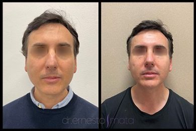 DR-ERNESTO-MATA-RONOPLASTIA-ULTRA26