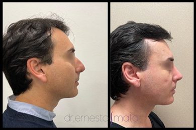 DR-ERNESTO-MATA-RONOPLASTIA-ULTRA27
