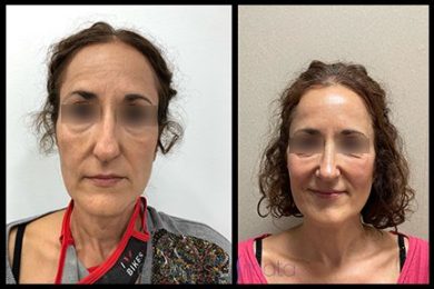 DR-ERNESTO-MATA-RONOPLASTIA-ULTRA28