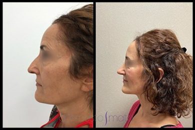 DR-ERNESTO-MATA-RONOPLASTIA-ULTRA29